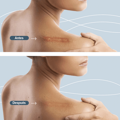 Cinta de Silicona para Cicatrices Corporales Tratamiento y prevención SLM01